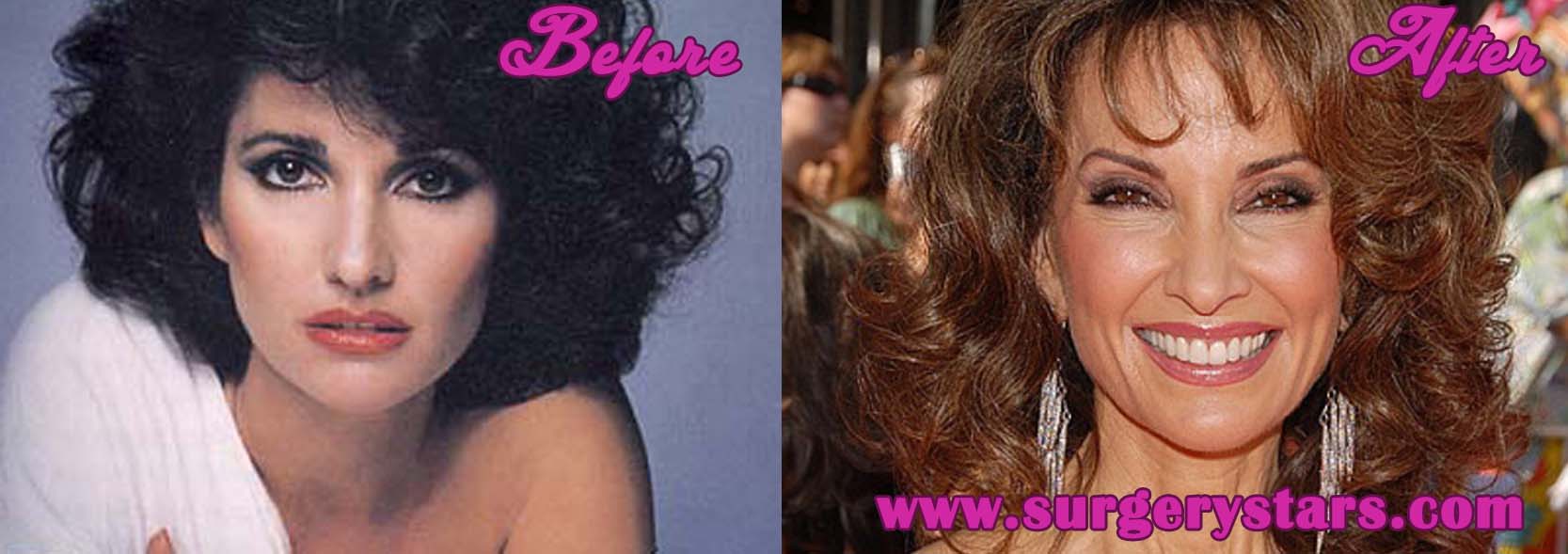 Susan Lucci Plastic Surgery - Before and After Pictures.
