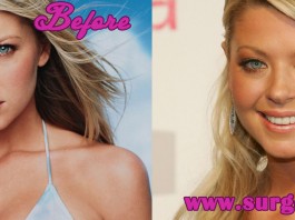 Tara Reid Plastic Surgery