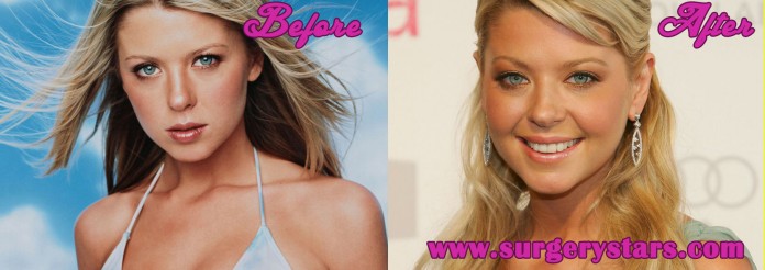 Tara Reid Plastic Surgery