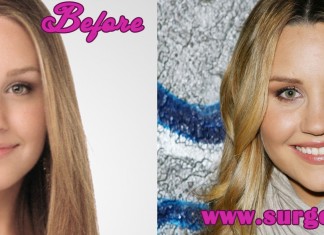 Amanda Bynes Plastic Surgery