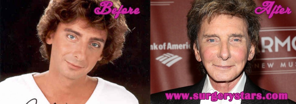 Barry Manilow Plastic Surgery