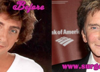 Barry Manilow Plastic Surgery