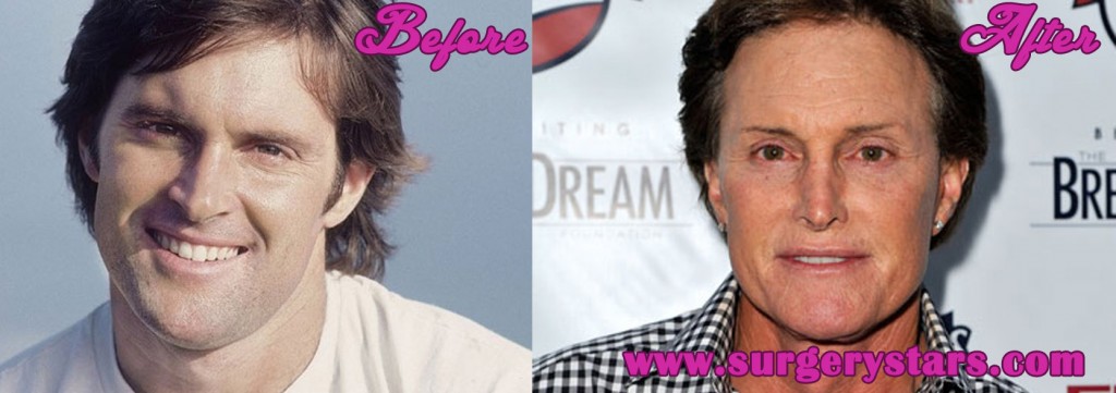 Bruce Jenner Plastic Surgery