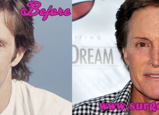 Bruce Jenner Plastic Surgery