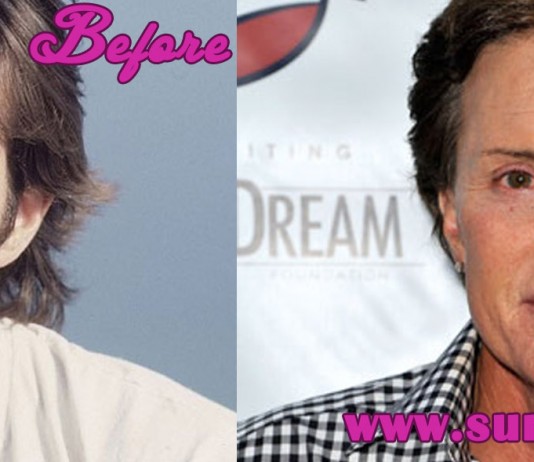 Bruce Jenner Plastic Surgery