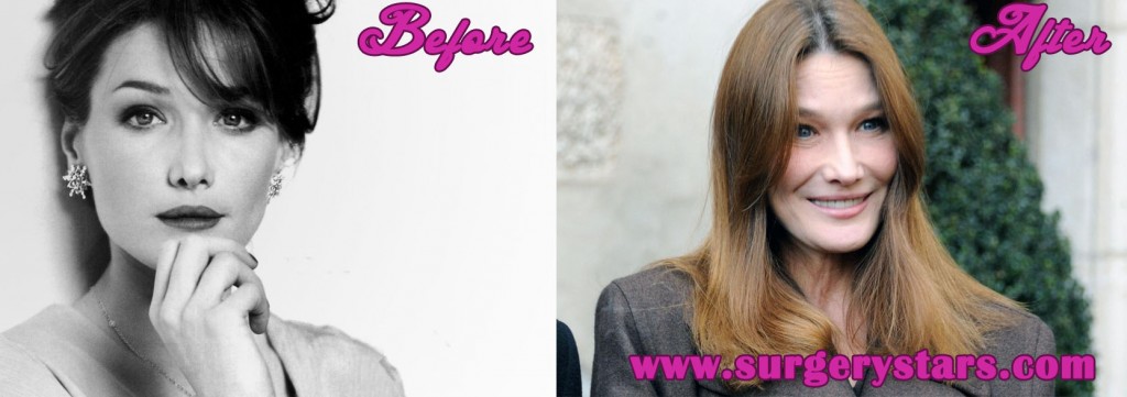 Carla Bruni Plastic Surgery