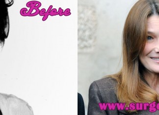 Carla Bruni Plastic Surgery