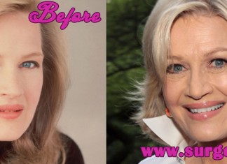 Diane Sawyer Plastic Surgery