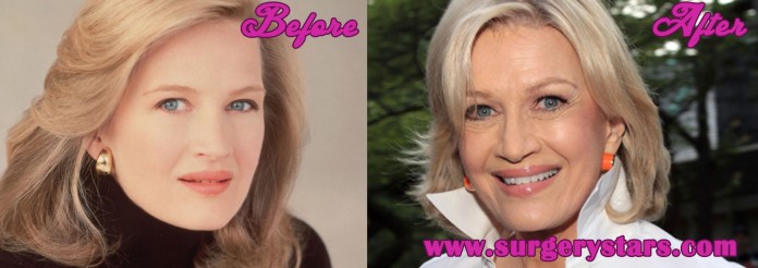 Diane Sawyer Plastic Surgery