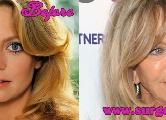 Goldie Hawn Plastic Surgery