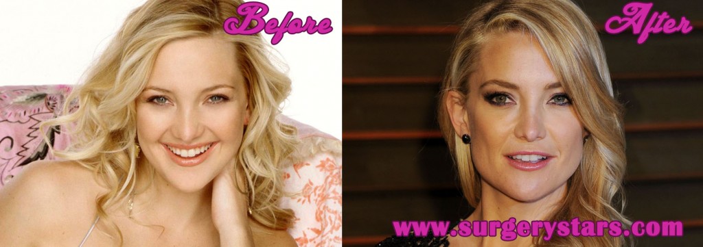 Kate Hudson Plastic Surgery