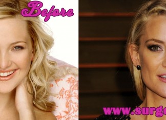 Kate Hudson Plastic Surgery