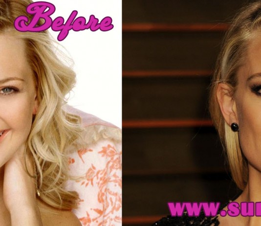 Kate Hudson Plastic Surgery