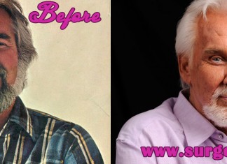 Kenny Rogers Plastic Surgery