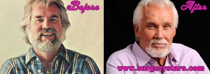 Kenny Rogers Plastic Surgery