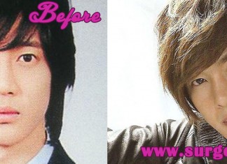 Kim Hyun Joong Plastic Surgery