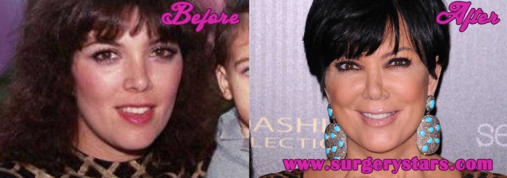 Kris Jenner Plastic Surgery