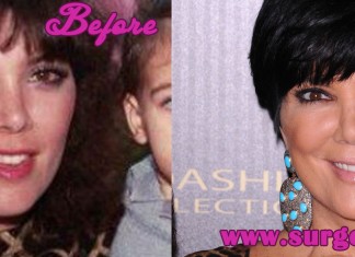 Kris Jenner Plastic Surgery