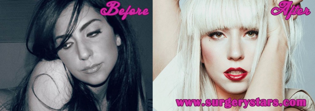 Lady Gaga Plastic Surgery