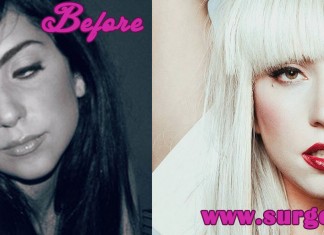 Lady Gaga Plastic Surgery