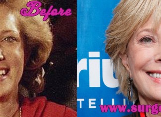 Leslie Stahl Plastic Surgery