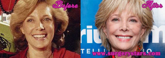 Leslie Stahl Plastic Surgery