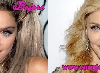 Madonna Plastic Surgery