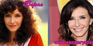 Mary Steenburgen Plastic Surgery