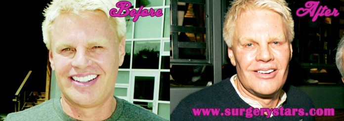 Mike Jeffries Plastic Surgery