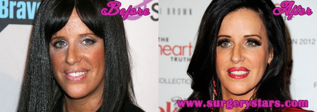 Patti Stanger Plastic Surgery