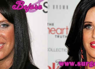 Patti Stanger Plastic Surgery
