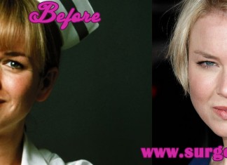 Renne Zellweger Plastic Surgery