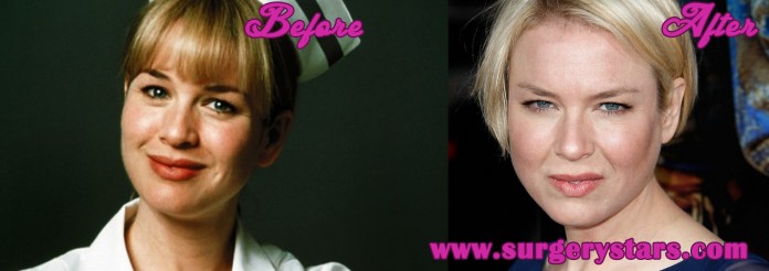 Renne Zellweger Plastic Surgery