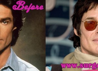 Ronn Moss Plastic Surgery
