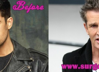 Rupert Everett Plastic Surgery