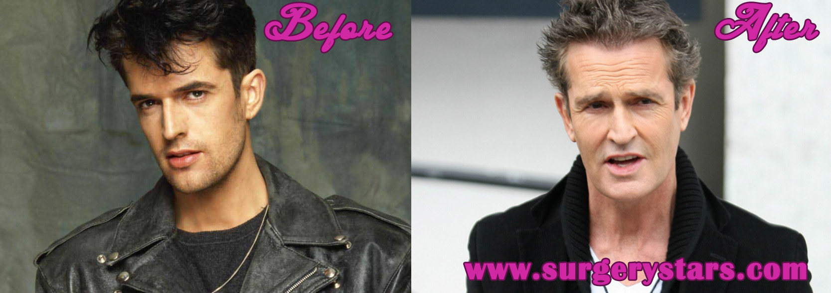 Rupert everett plastic surgery