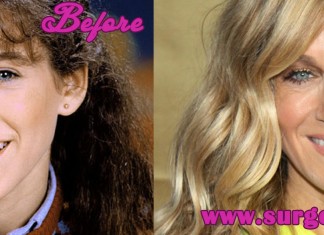 Sarah Jessica Parker Plastic Surgery