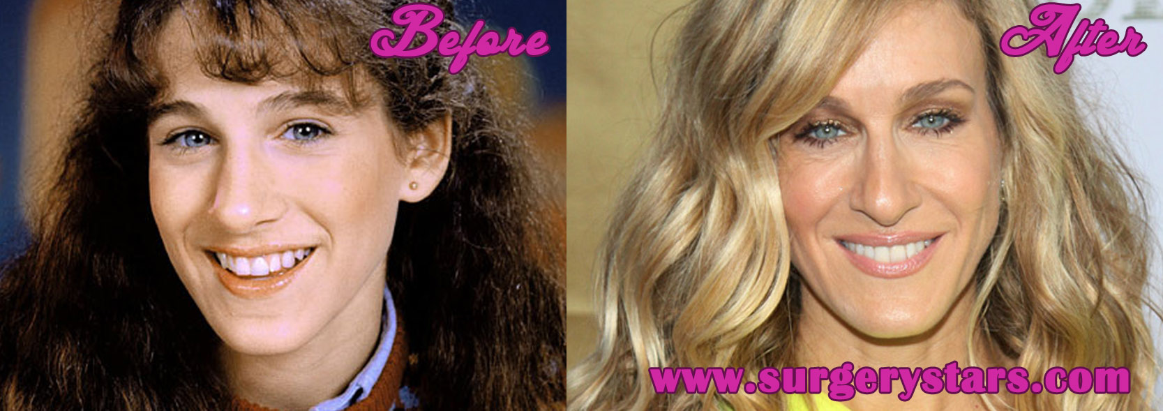 Sarah Jessica Parker Plastic Surgery - Before and After Pictures.