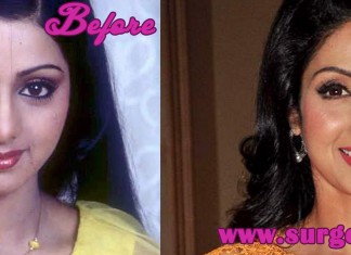 Sridevi Plastic Surgery