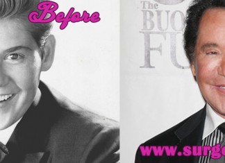 Wayne Newton Plastic Surgery