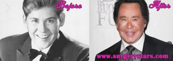 Wayne Newton Plastic Surgery