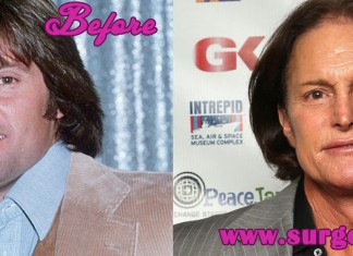 Worst Plastic Surgery Bruce Jenner