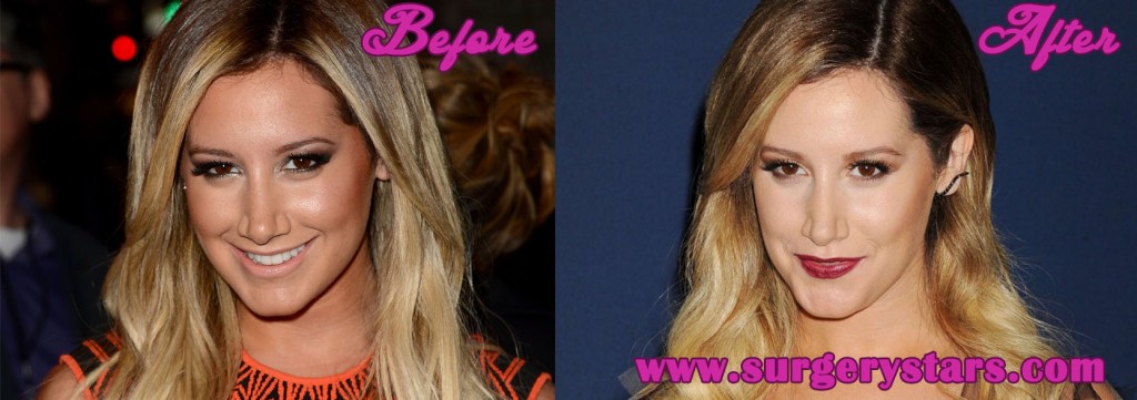 Ashley Tisdale Plastic Surgery