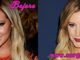 Ashley Tisdale Plastic Surgery