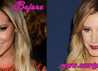 Ashley Tisdale Plastic Surgery