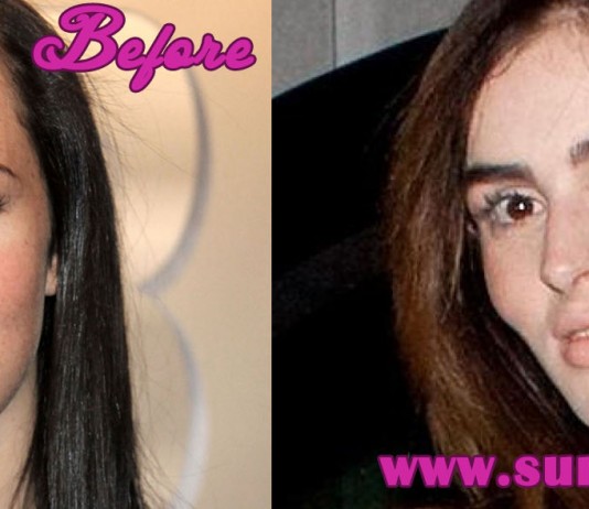 Ali Lohan Plastic Surgery