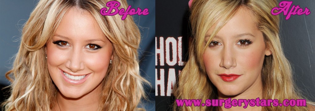 Ashley Tisdale Nose Job