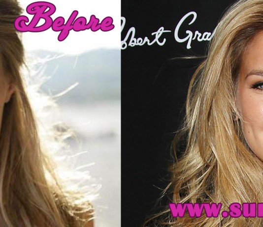 Bar Refaeli Plastic Surgery