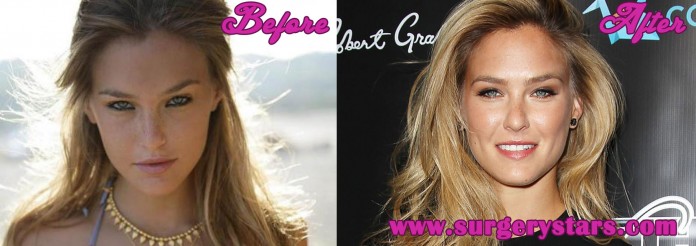 Bar Refaeli Plastic Surgery