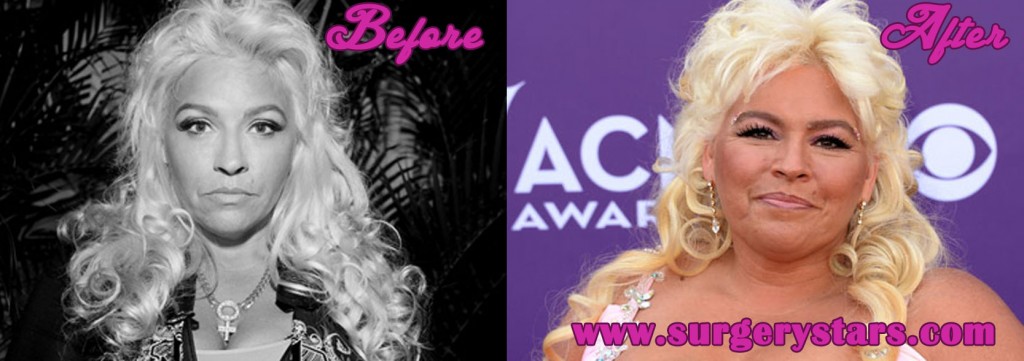 Beth Chapman Plastic Surgery